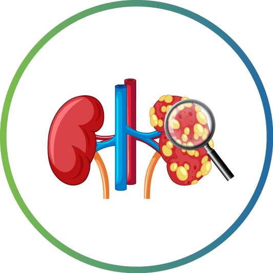 Nephrotic Syndrome