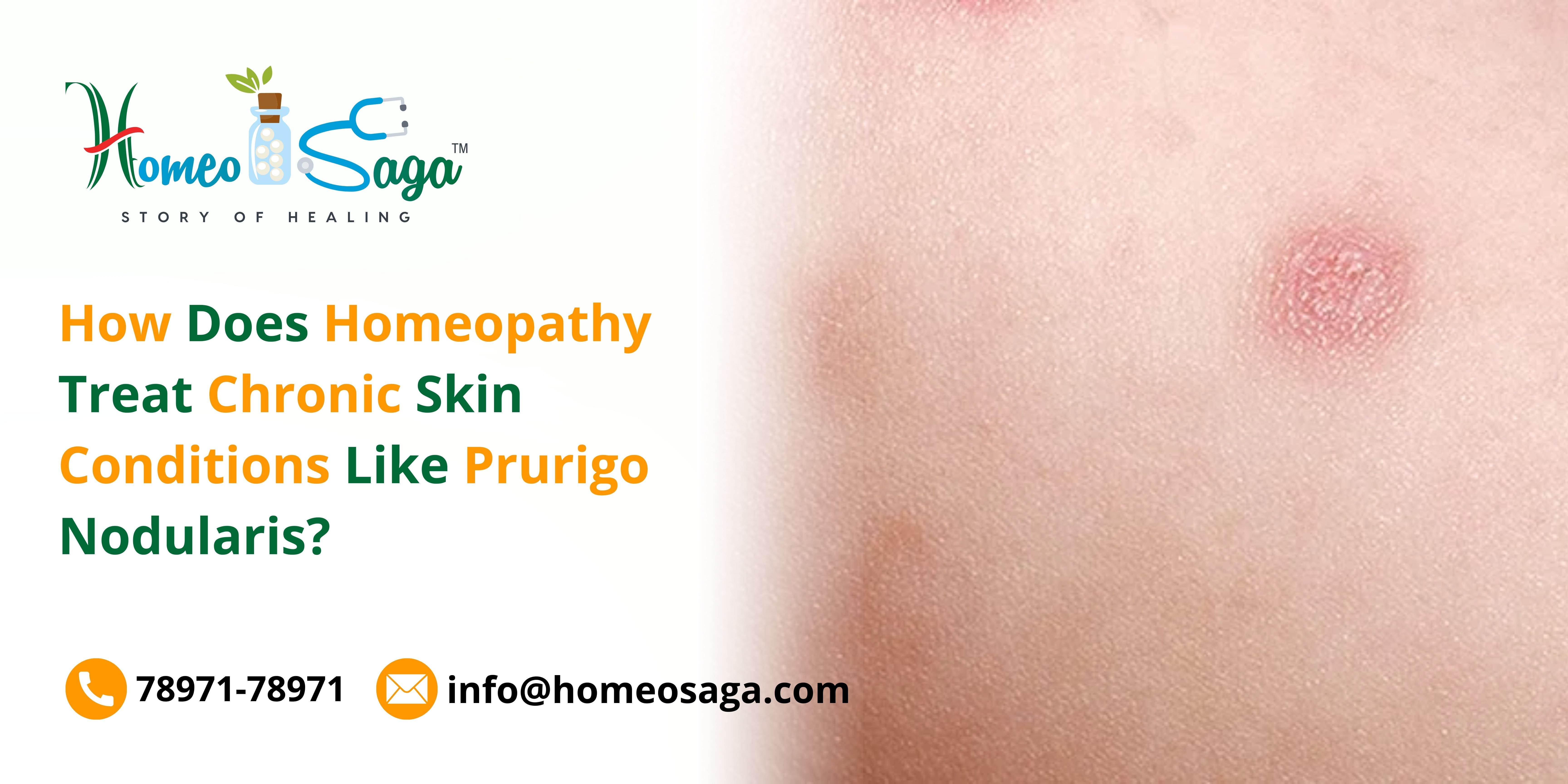 How Does Homeopathy Treat Chronic Skin Conditions Like Prurigo Nodularis?