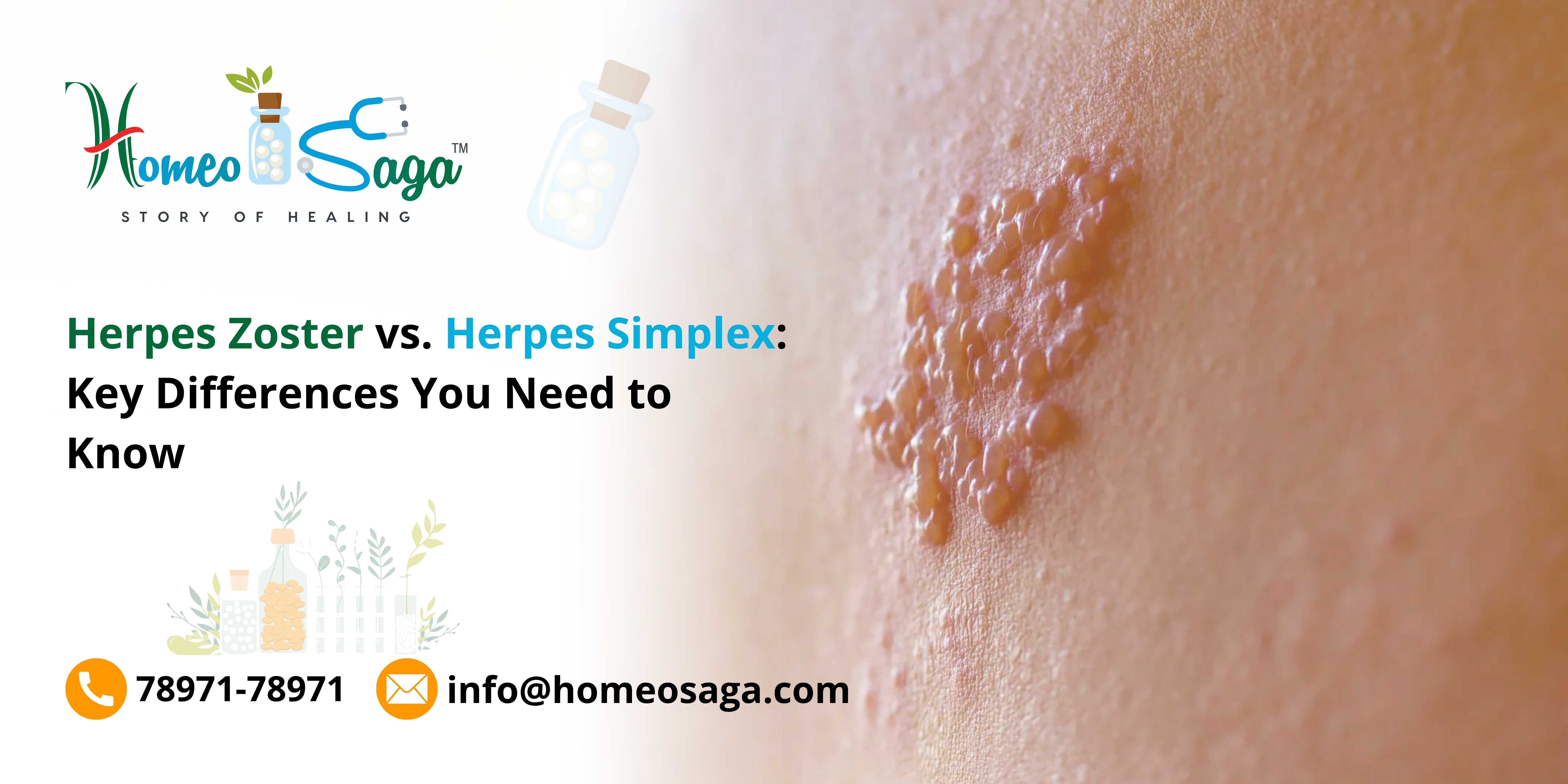 Herpes Zoster vs. Herpes Simplex: Key Differences You Need to Know