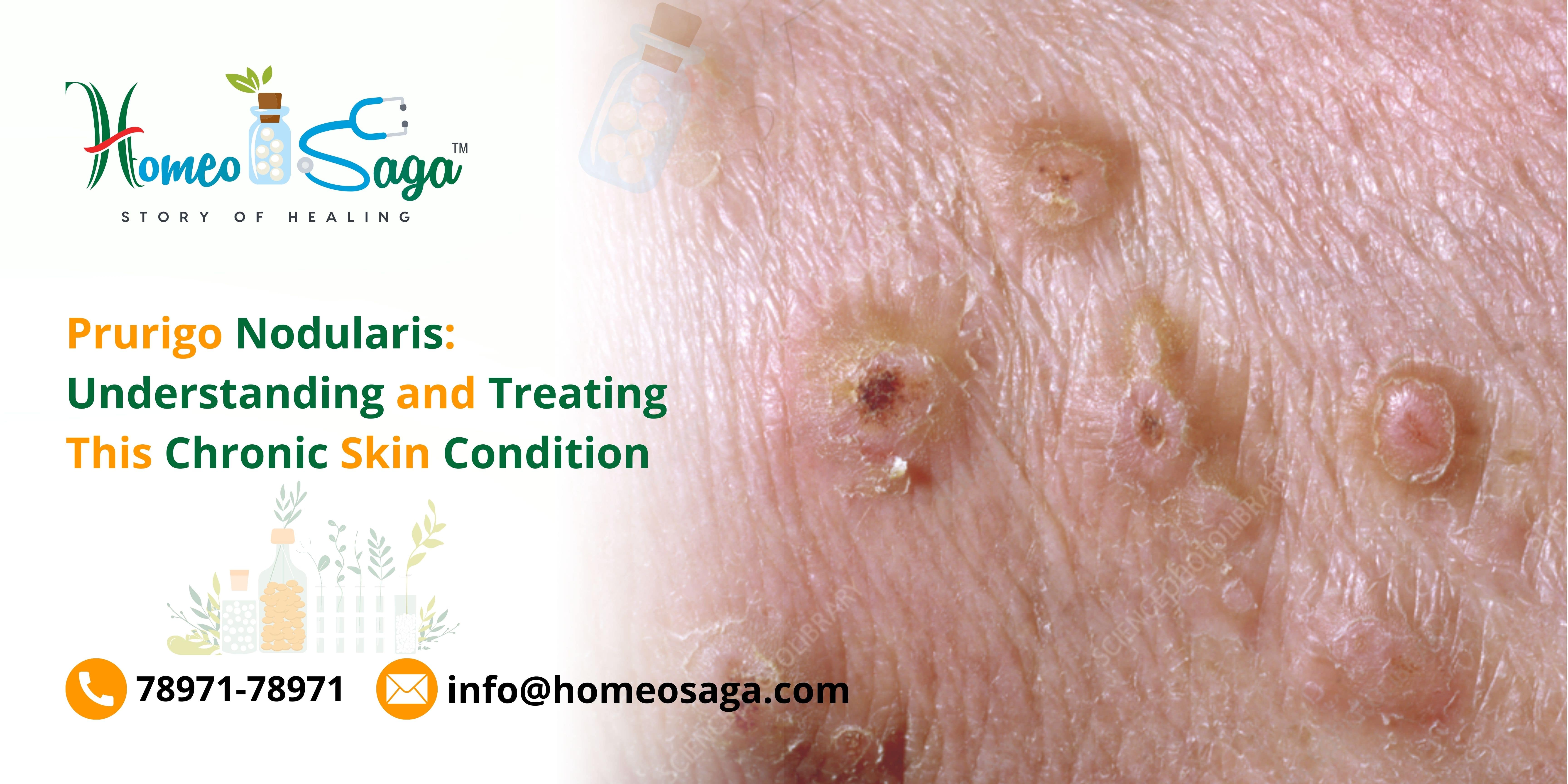 Prurigo Nodularis Understanding and Treating This Chronic Skin Condition